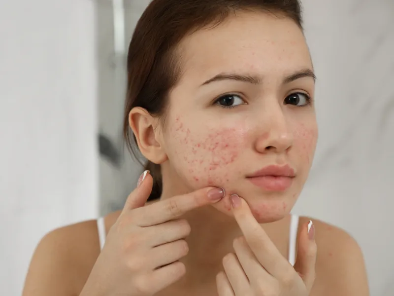 Dấu Hiệu Làn Da Bạn Đang Bị Kích Ứng Mỹ Phẩm