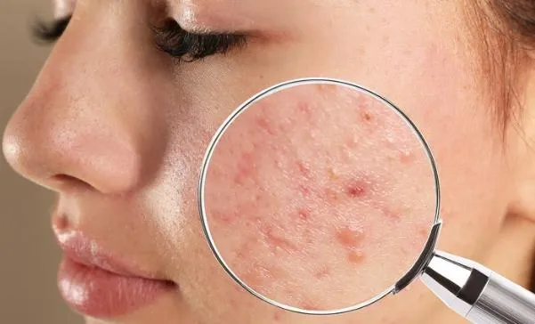 Hiểu Rõ Nguyên Nhân Gây Mụn Của Bạn
